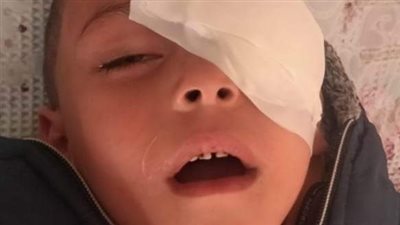 فقأت عينه لكثرة بكائه.. نيابة المحلة تحقق في واقعة اعتداء معلمة على طفل