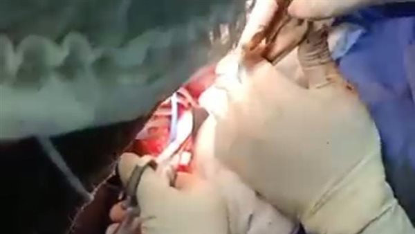 استئصال ورم من سيدة