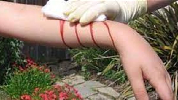  التئام الجروح