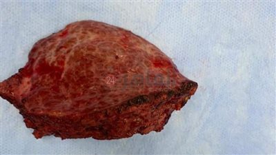 مركز أورام المنيا ينجح في إجراء عملية جراحية معقدة واستئصال ورم سرطان كبير بالكبد