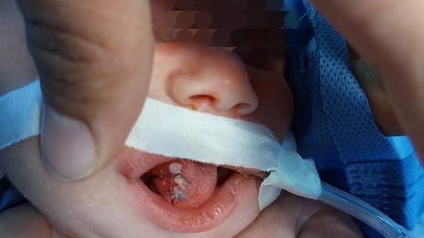 الرضيعة المصابة بورم