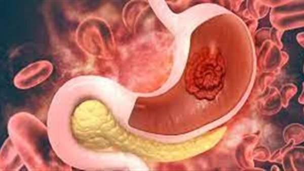 سرطان المعدة