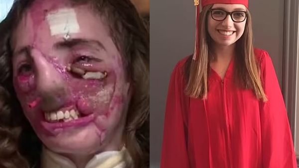 دوراند قبل وبعد الإصابة