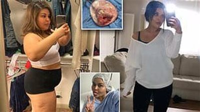 ورم حميد من الشعر والأسنان يسكن بطن فتاة لمدة عشرين عامًا