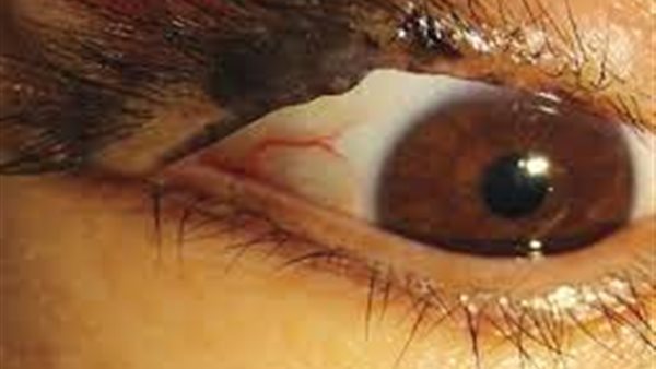 سرطان العين