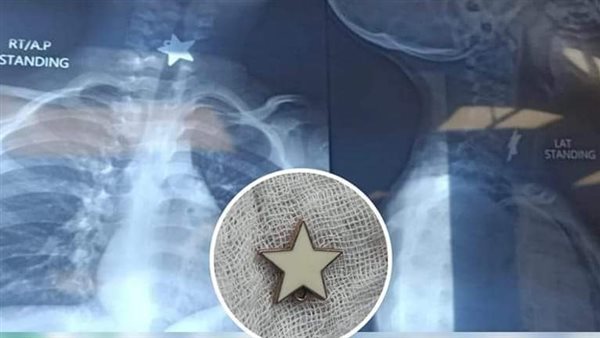 طفل يبتلع سلسلة 