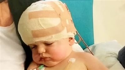 نجاح عملية جمع جمجمة طفل أصيب بمرض نادر يؤدي إلى تكسير الدماغ
