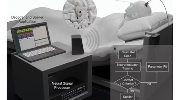 زراعة دماغ -تعبيرية