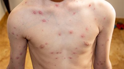 غلق مدرسة بكفر الشيخ لمدة 3 أيام بعد إصابة 12 طالب بـ”الجدري”