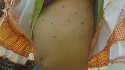 بعد إصابة بعض الطلاب بالجدري.. صحة كفر الشيخ توضح أعراض المرض والإجرائات الوقائية