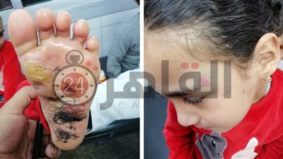 “جنة” جديدة.. أم تعذب طفلتها بآلة حادة ساخنة وتصيبها بحروق وقروح خطيرة بالدقهلية (صور)