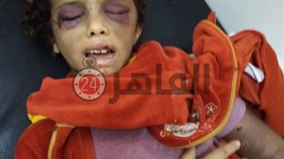 جنة جديدة بالشرقية.. ربة منزل تعذب ابنة شقيقتها بطريقة وحشية في بلبيس (صور)