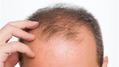 الحل الأفضل لعلاج تساقط الشعر