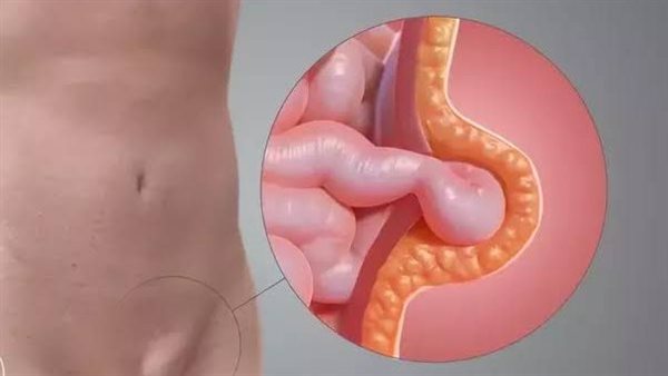 الفتق الإربي 