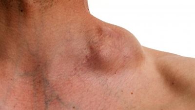 الغذاء والدواء الأمريكية توافق على دواء لعلاج سرطان الغدد الليمفاوية