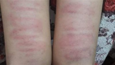 طفل يتعرض للضرب المبرح من معلمه لعدم حفظه القرآن الكريم.. والوالد يحرر محضرًا