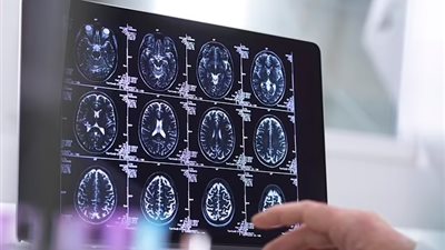 بريطانيا تعلن قريبا عن اكتشاف أول علاج فعال لمرض الخرف 