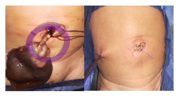 صورة حية من جراحة