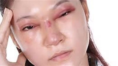 من بينها فشل القلب.. تعرف على مرض شاغاس الصامت وأعراضه