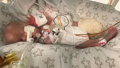 بعد بتر ساق طفل حديث الولادة بسببها..ماهي عدوى القولون الناخر النادرة