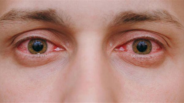 إحمرار العين