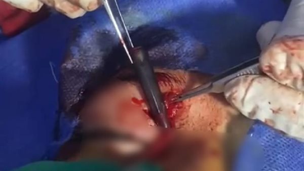 استخراج قلم من عين