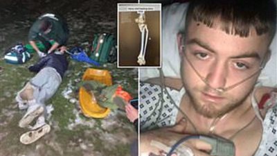 لم يستطع تحمل الألم.. مراهق يطالب الأطباء بقطع قدميه بعد إصابته بكسور في حادث أفقده القدرة على الحركة 