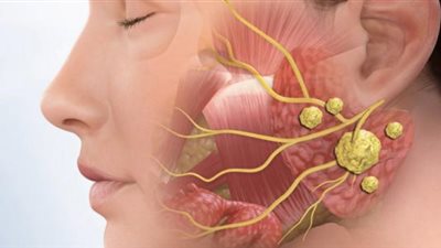 صعوبة في البلع.. تعرف على سرطان الغدد اللعابية وأعراضه وأنواعه
