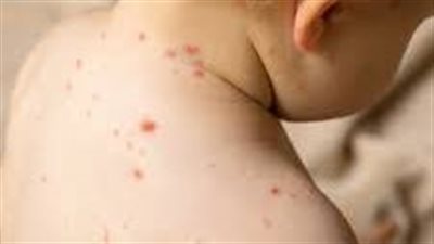 بريطانيا تشهد ضعف حالات إصابة بالحصبة بالمقارنة بالسنوات الماضية