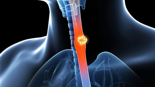 سرطان المريء