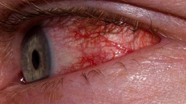 التهاب العين