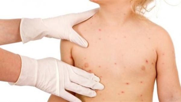 الجدري المائي عند