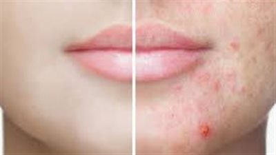 عدم استخدام المنتجات الزيتية.. نصائح للوقاية من حب الشباب