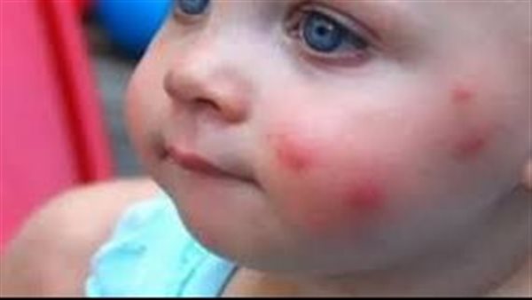 لدغات الناموس