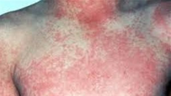 الحمى النزفية