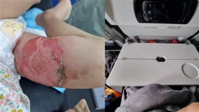 سيدة تقدم شكوى بعد تعرض طفلتها للحرق على متن رحلة للخطوط الجوية القطرية