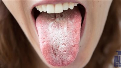 كيف يصبح جفاف الفم مشكلة صحية خطيرة؟