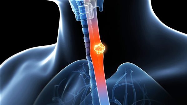 سرطان المريء