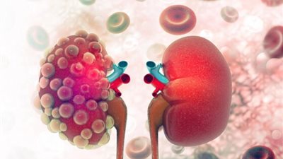 كيف يؤثر التلف الكلوي على صحة الجلد؟