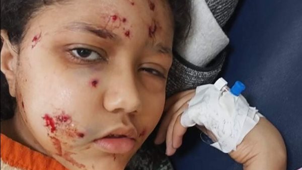 الطفلة المصابة حنين