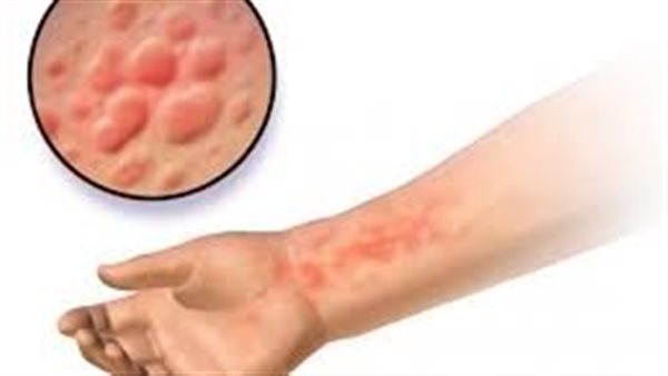 الحساسية المفرطة