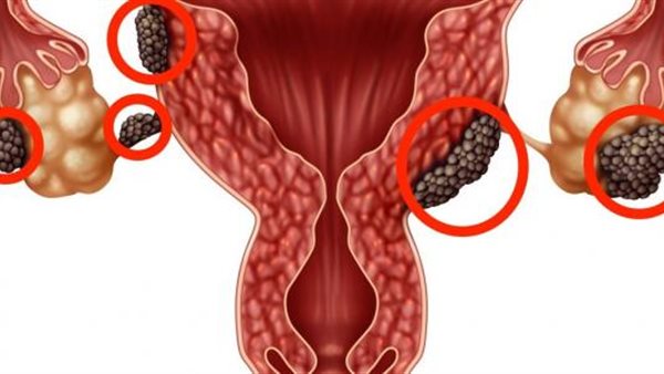 تكيس المبايض