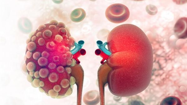  التلف الكلوي 