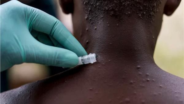 مرض جدري القرود