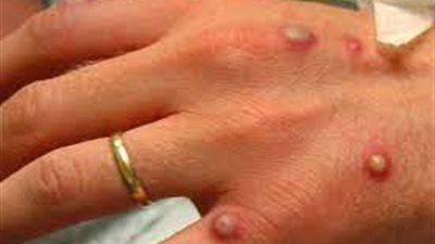 خبراء بريطانيون: حالات جدري القرود ليس لها مثيل والاتصال الجنسي طريق انتقال العدوى