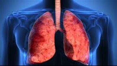منها سعال جاف مزمن.. تعرف على تليف الرئة وأعراضه