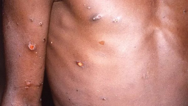 مرض جدري القرود