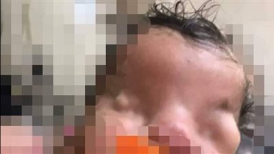 نادرة من نوعها.. قصة ولادة طفلة جفون عينيها ملتصقة
