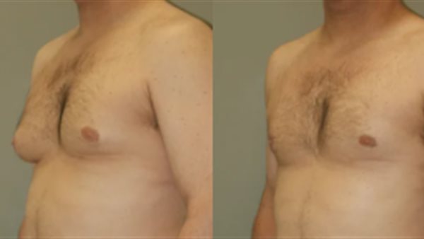 التثدي عند الرجال