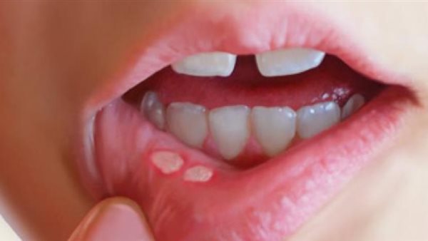 البقع البيضاء في